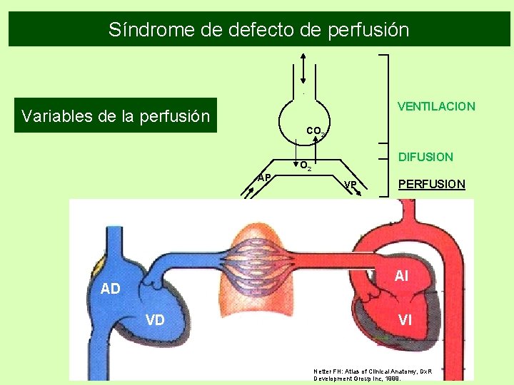 Síndrome de defecto de perfusión VENTILACION Variables de la perfusión CO 2 DIFUSION O Síndrome de defecto de perfusión VENTILACION Variables de la perfusión CO 2 DIFUSION O