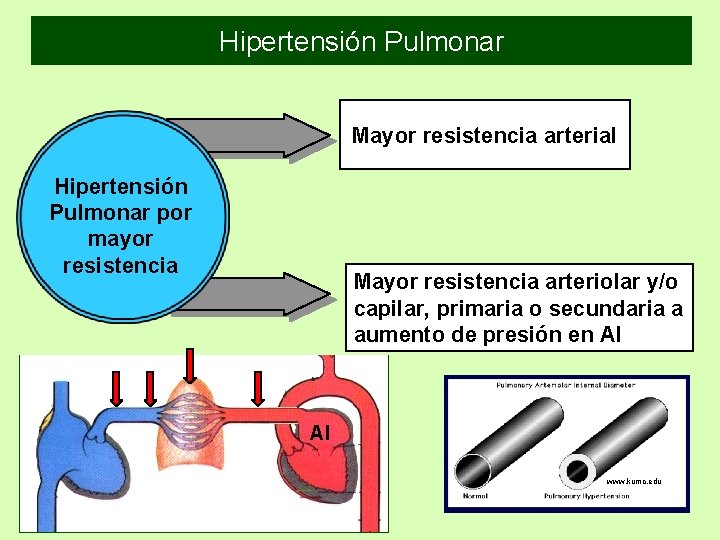Hipertensión Pulmonar Mayor resistencia arterial Hipertensión Pulmonar por mayor resistencia Mayor resistencia arteriolar y/o Hipertensión Pulmonar Mayor resistencia arterial Hipertensión Pulmonar por mayor resistencia Mayor resistencia arteriolar y/o