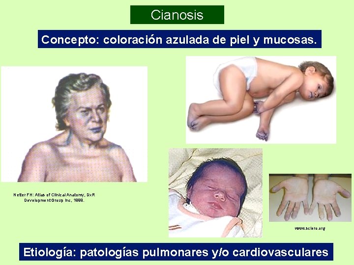 Cianosis Concepto: coloración azulada de piel y mucosas. Netter FH: Atlas of Clinical Anatomy, Cianosis Concepto: coloración azulada de piel y mucosas. Netter FH: Atlas of Clinical Anatomy,