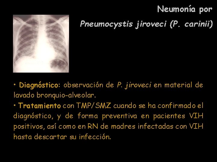 Neumonía por Pneumocystis jiroveci (P. carinii) • Diagnóstico: observación de P. jiroveci en material