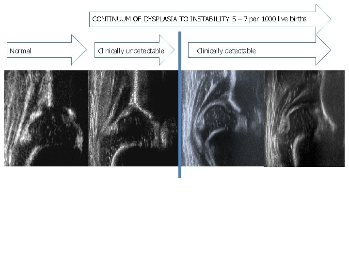 CONTINUUM OF DYSPLASIA TO INSTABILITY 5 – 7 per 1000 live births Normal Clinically