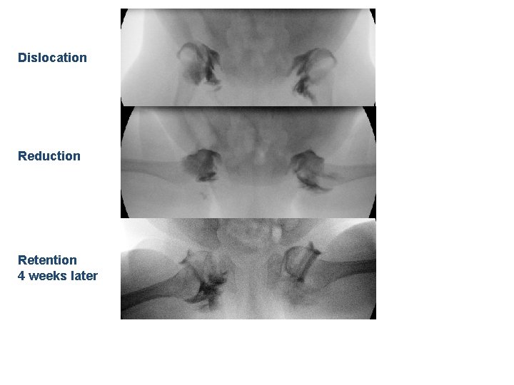 Dislocation Reduction Retention 4 weeks later 