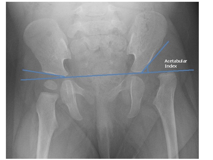 Acetabular Index 