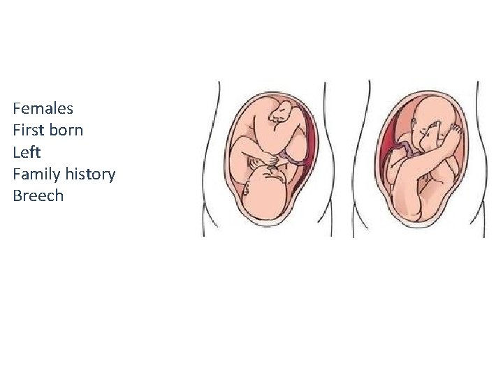 Females First born Left Family history Breech 