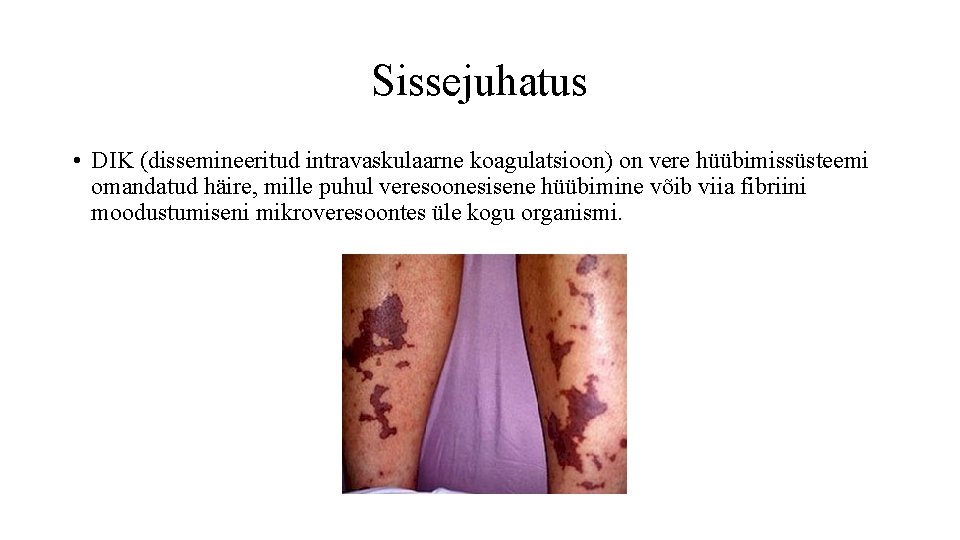 Sissejuhatus • DIK (dissemineeritud intravaskulaarne koagulatsioon) on vere hüübimissüsteemi omandatud häire, mille puhul veresoonesisene