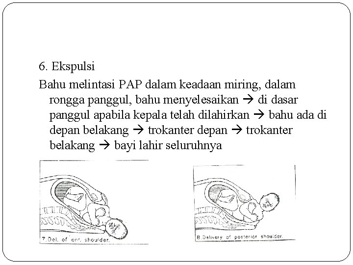 6. Ekspulsi Bahu melintasi PAP dalam keadaan miring, dalam rongga panggul, bahu menyelesaikan di