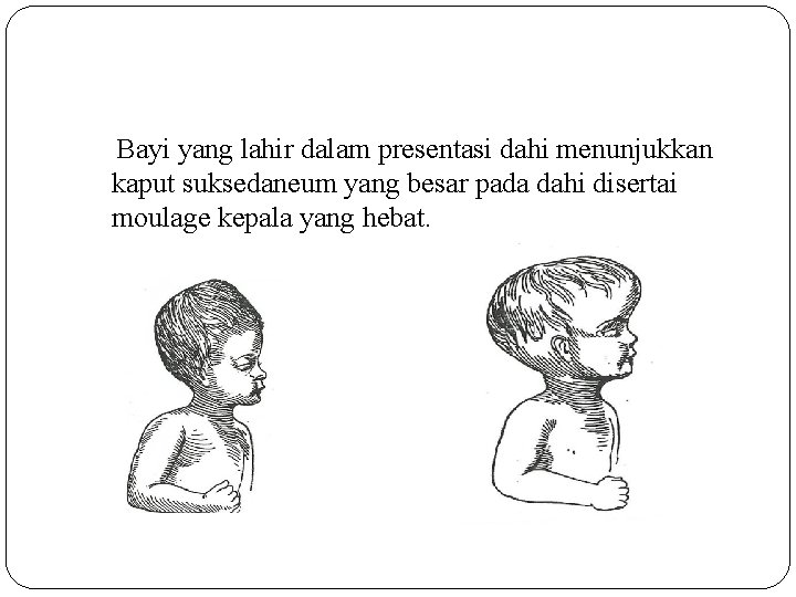 Bayi yang lahir dalam presentasi dahi menunjukkan kaput suksedaneum yang besar pada dahi disertai