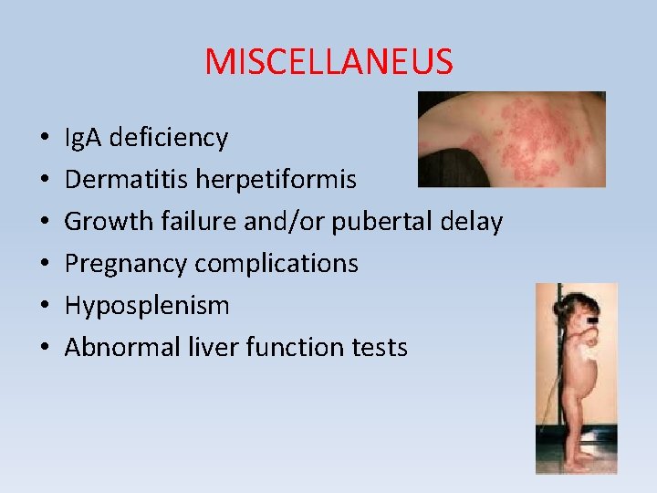 MISCELLANEUS • • • Ig. A deficiency Dermatitis herpetiformis Growth failure and/or pubertal delay