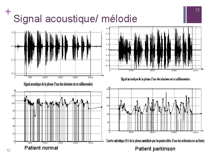 + 12 12 Signal acoustique/ mélodie Patient normal Patient parkinson 