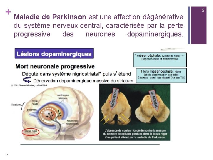 + Maladie de Parkinson est une affection dégénérative du système nerveux central, caractérisée par