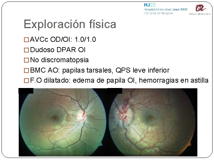 Exploración física � AVCc OD/OI: 1. 0/1. 0 � Dudoso DPAR OI � No