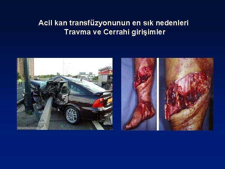 Acil kan transfüzyonunun en sık nedenleri Travma ve Cerrahi girişimler 