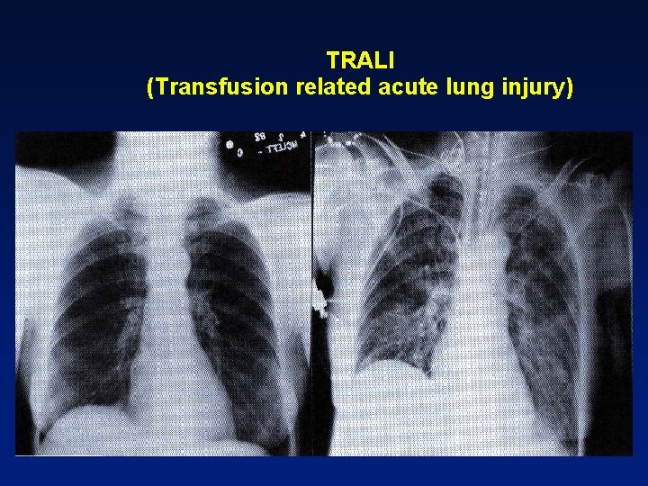 TRALI (Transfusion related acute lung injury) 