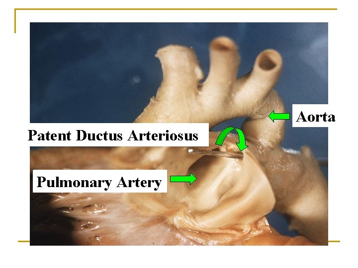 Aorta Patent Ductus Arteriosus Pulmonary Artery 