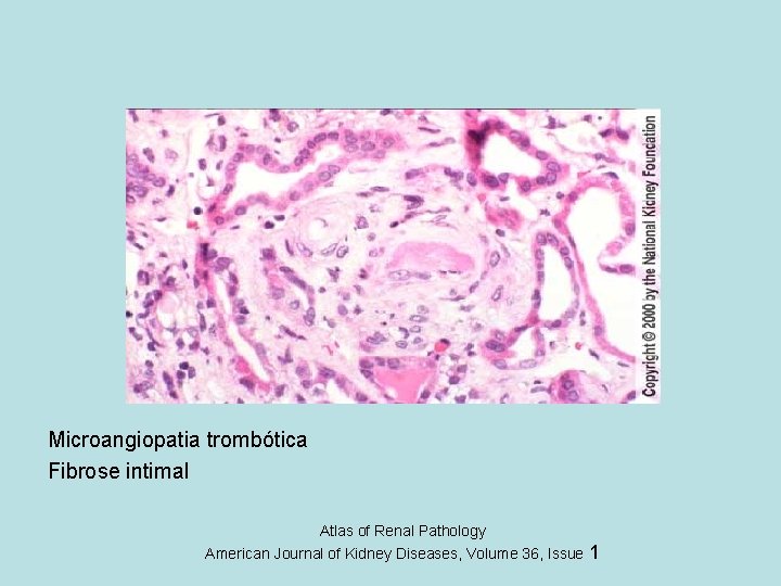 Microangiopatia trombótica Fibrose intimal Atlas of Renal Pathology American Journal of Kidney Diseases, Volume