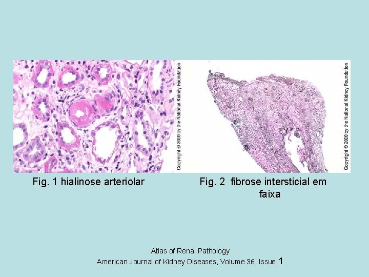 Fig. 1 hialinose arteriolar Fig. 2 fibrose intersticial em faixa Atlas of Renal Pathology