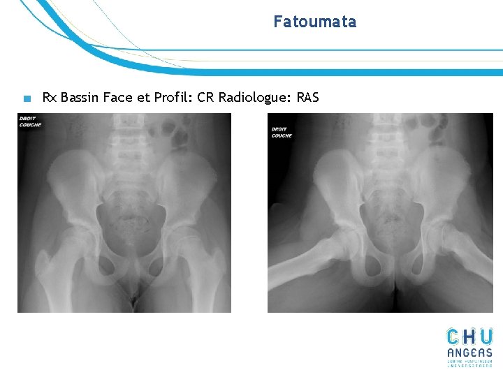 Fatoumata ■ Rx Bassin Face et Profil: CR Radiologue: RAS Fatoumata ■ Rx Bassin Face et Profil: CR Radiologue: RAS