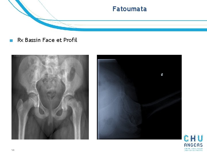 Fatoumata ■ Rx Bassin Face et Profil 14 Fatoumata ■ Rx Bassin Face et Profil 14