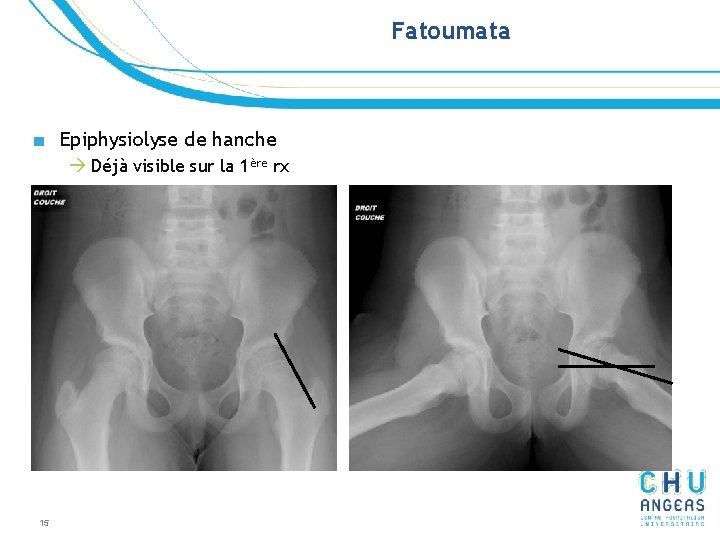 Fatoumata ■ Epiphysiolyse de hanche à Déjà visible sur la 1ère rx 15 Fatoumata ■ Epiphysiolyse de hanche à Déjà visible sur la 1ère rx 15