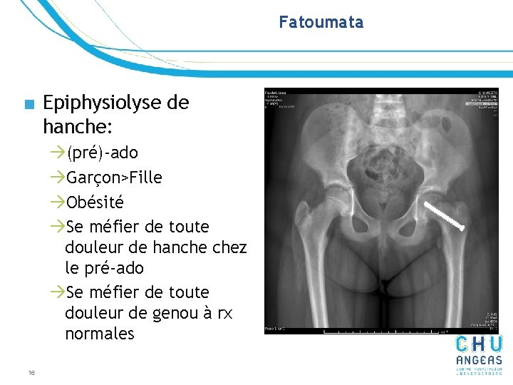 Fatoumata ■ Epiphysiolyse de hanche: à(pré)-ado àGarçon>Fille àObésité àSe méfier de toute douleur de Fatoumata ■ Epiphysiolyse de hanche: à(pré)-ado àGarçon>Fille àObésité àSe méfier de toute douleur de