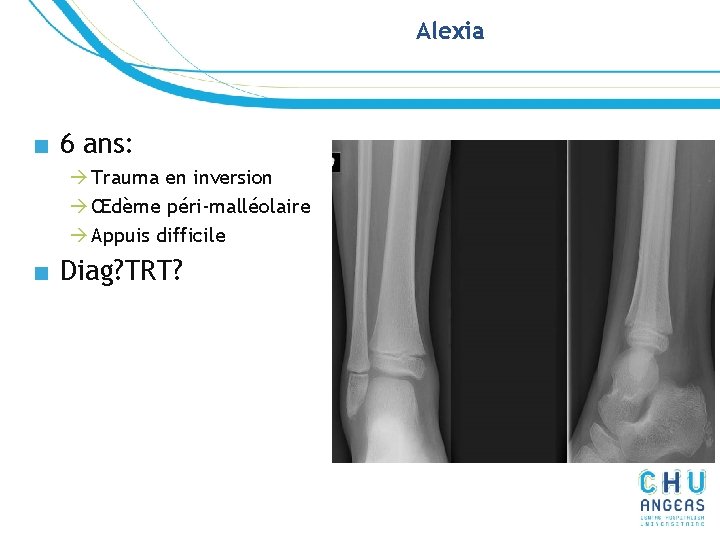 Alexia ■ 6 ans: à Trauma en inversion à Œdème péri-malléolaire à Appuis difficile Alexia ■ 6 ans: à Trauma en inversion à Œdème péri-malléolaire à Appuis difficile