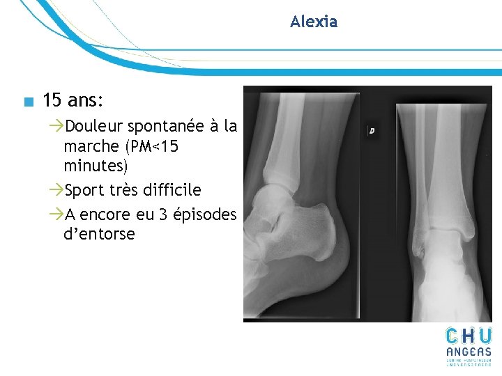 Alexia ■ 15 ans: àDouleur spontanée à la marche (PM<15 minutes) àSport très difficile Alexia ■ 15 ans: àDouleur spontanée à la marche (PM<15 minutes) àSport très difficile