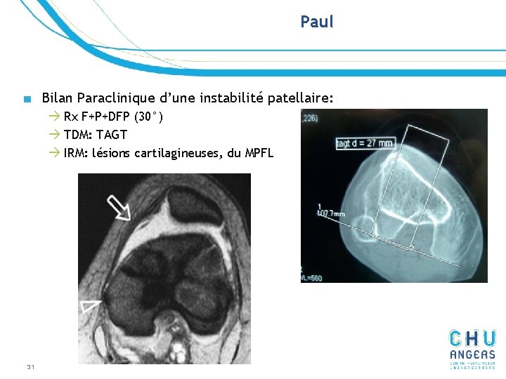 Paul ■ Bilan Paraclinique d’une instabilité patellaire: à Rx F+P+DFP (30°) à TDM: TAGT Paul ■ Bilan Paraclinique d’une instabilité patellaire: à Rx F+P+DFP (30°) à TDM: TAGT