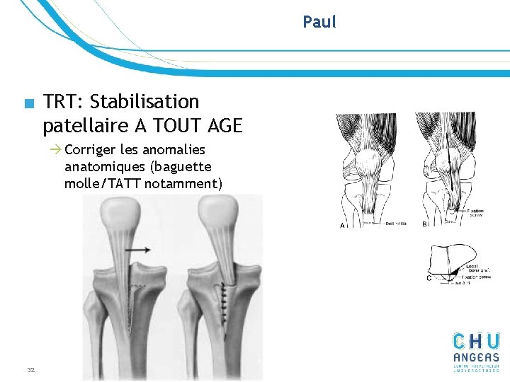 Paul ■ TRT: Stabilisation patellaire A TOUT AGE à Corriger les anomalies anatomiques (baguette Paul ■ TRT: Stabilisation patellaire A TOUT AGE à Corriger les anomalies anatomiques (baguette