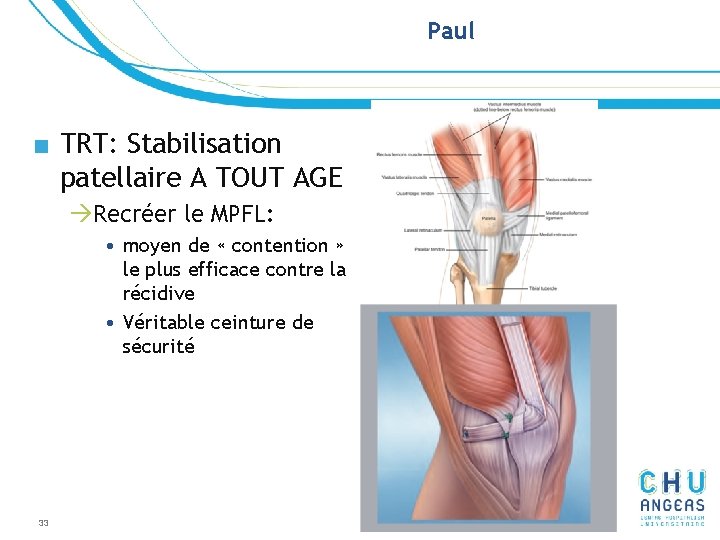 Paul ■ TRT: Stabilisation patellaire A TOUT AGE àRecréer le MPFL: • moyen de Paul ■ TRT: Stabilisation patellaire A TOUT AGE àRecréer le MPFL: • moyen de