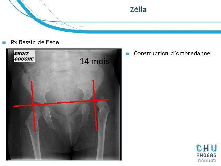 Zélia ■ Rx Bassin de Face ■ Construction d’ombredanne Zélia ■ Rx Bassin de Face ■ Construction d’ombredanne