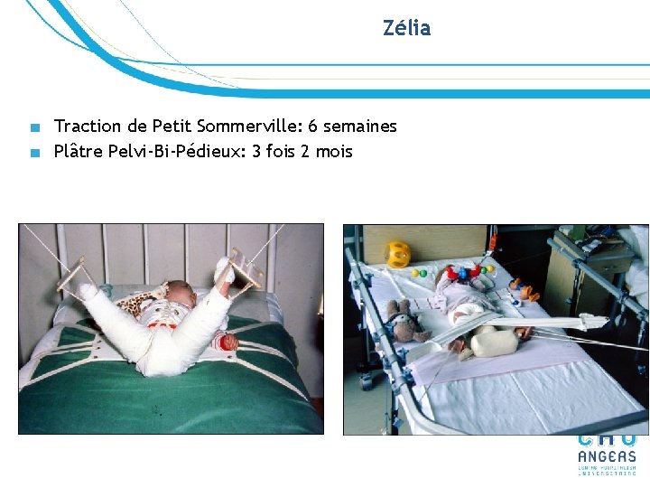 Zélia ■ Traction de Petit Sommerville: 6 semaines ■ Plâtre Pelvi-Bi-Pédieux: 3 fois 2 Zélia ■ Traction de Petit Sommerville: 6 semaines ■ Plâtre Pelvi-Bi-Pédieux: 3 fois 2