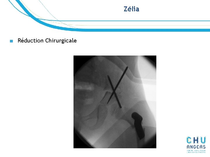 Zélia ■ Réduction Chirurgicale Zélia ■ Réduction Chirurgicale