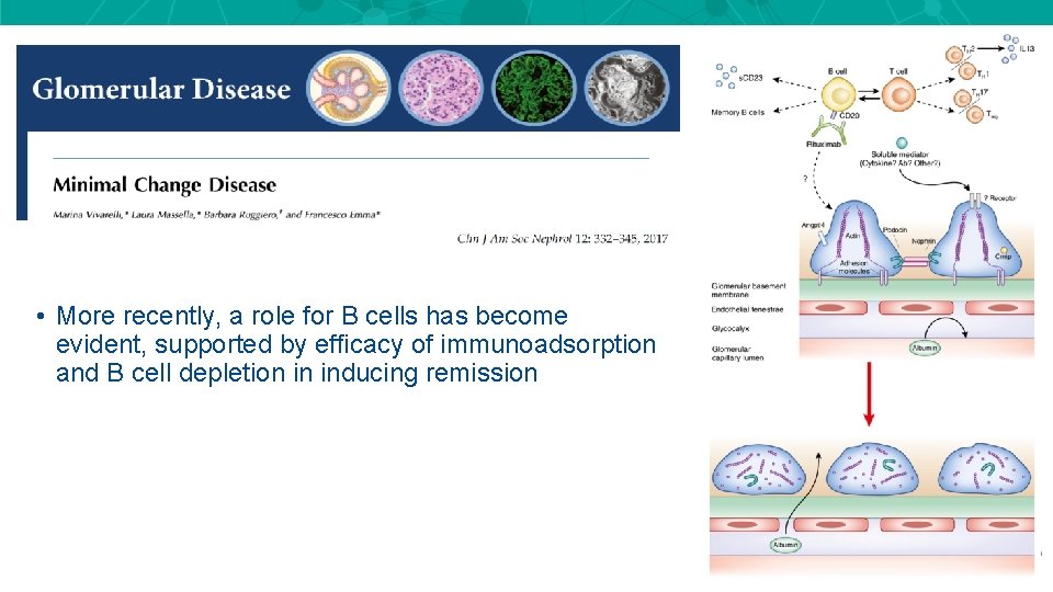 • More recently, a role for B cells has become evident, supported by • More recently, a role for B cells has become evident, supported by