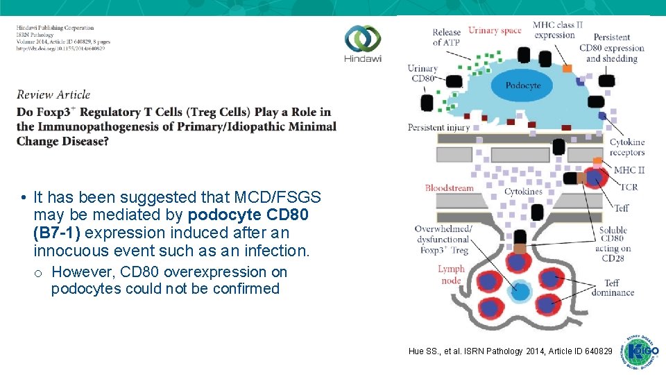 • It has been suggested that MCD/FSGS may be mediated by podocyte CD • It has been suggested that MCD/FSGS may be mediated by podocyte CD