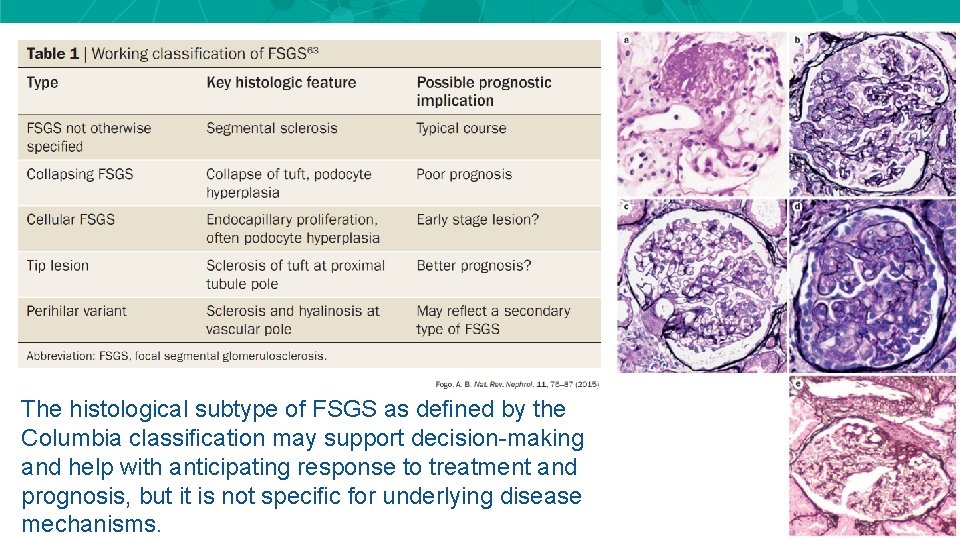 The histological subtype of FSGS as defined by the Columbia classification may support decision-making The histological subtype of FSGS as defined by the Columbia classification may support decision-making