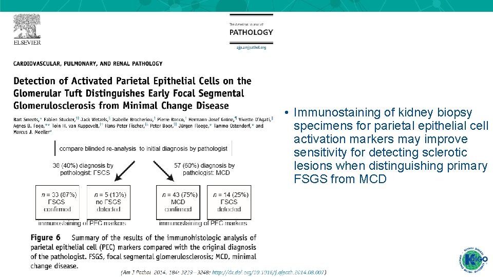 • Immunostaining of kidney biopsy specimens for parietal epithelial cell activation markers may • Immunostaining of kidney biopsy specimens for parietal epithelial cell activation markers may