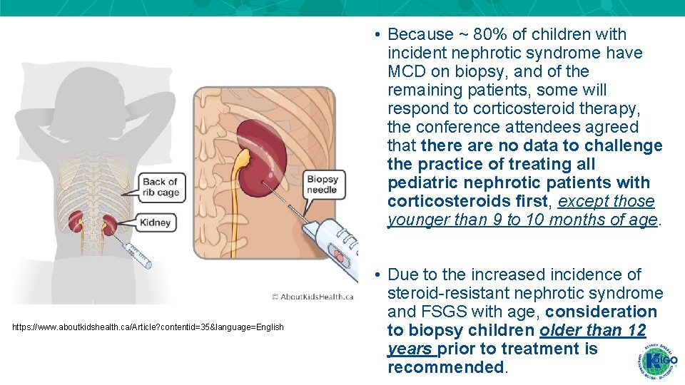 • Because ~ 80% of children with incident nephrotic syndrome have MCD on • Because ~ 80% of children with incident nephrotic syndrome have MCD on