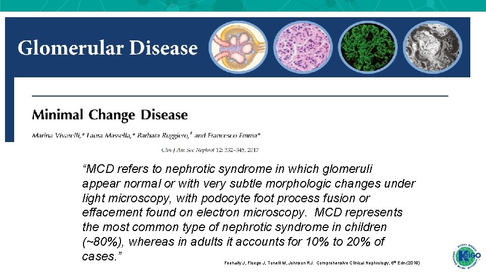 “MCD refers to nephrotic syndrome in which glomeruli appear normal or with very subtle “MCD refers to nephrotic syndrome in which glomeruli appear normal or with very subtle