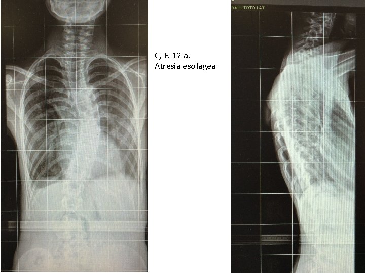 C, F. 12 a. Atresia esofagea 
