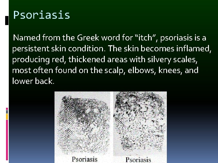Psoriasis Named from the Greek word for “itch”, psoriasis is a persistent skin condition.