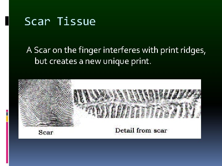 Scar Tissue A Scar on the finger interferes with print ridges, but creates a