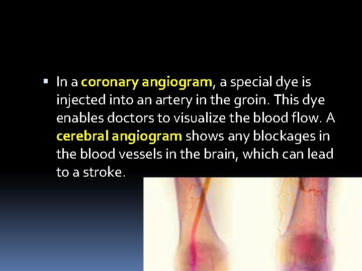  In a coronary angiogram, a special dye is injected into an artery in