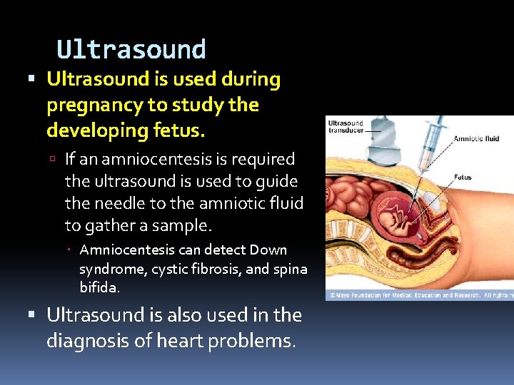 Ultrasound is used during pregnancy to study the developing fetus. If an amniocentesis is