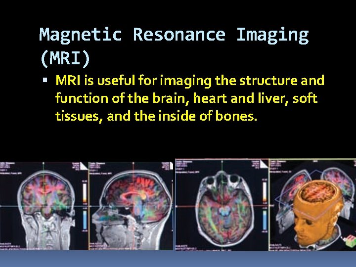 Magnetic Resonance Imaging (MRI) MRI is useful for imaging the structure and function of