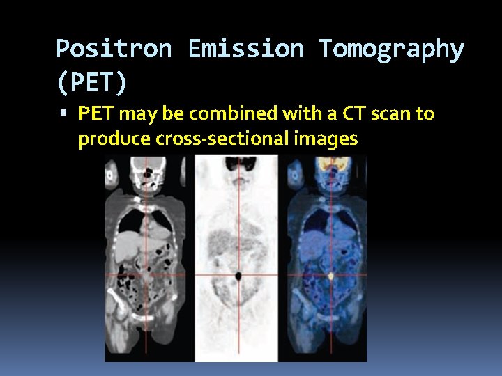 Positron Emission Tomography (PET) PET may be combined with a CT scan to produce