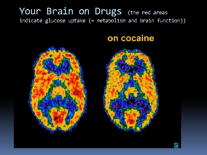 Your Brain on Drugs (the red areas indicate glucose uptake (= metabolism and brain