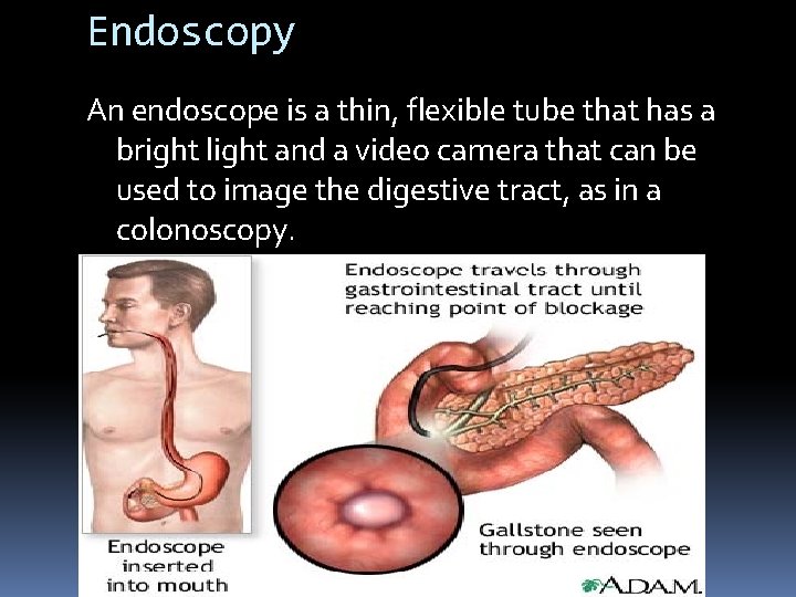 Endoscopy An endoscope is a thin, flexible tube that has a bright light and