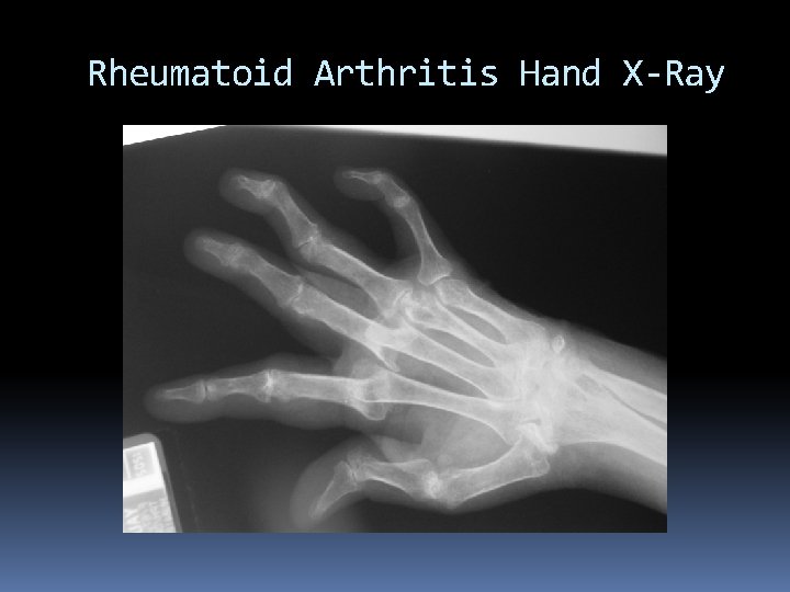 Rheumatoid Arthritis Hand X-Ray 