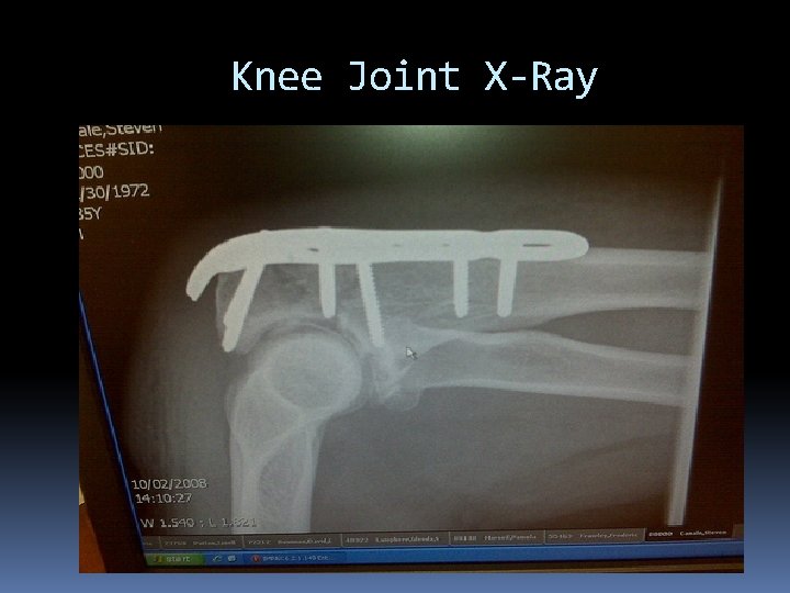 Knee Joint X-Ray 