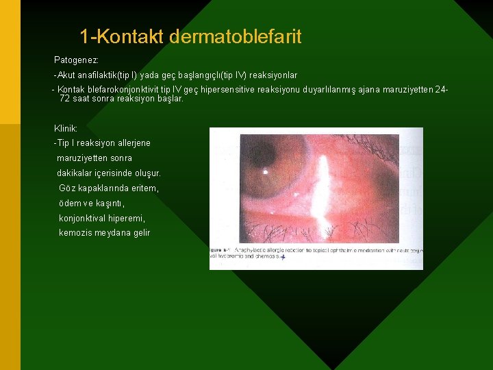 1 -Kontakt dermatoblefarit Patogenez: -Akut anafilaktik(tip I) yada geç başlangıçlı(tip IV) reaksiyonlar - Kontak